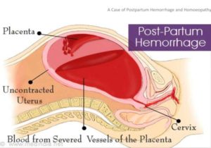 Post-Partum Hemorrhage