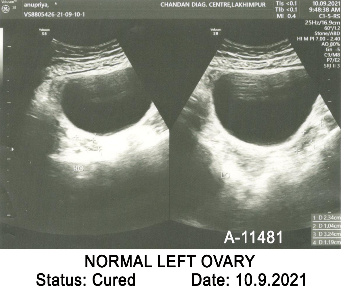 An evidence-based case of haemorrhagic left ovarian cyst cured by ...